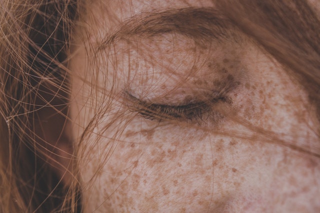 Hyperpigmentation Uncovered: From Melasma to Post-Inflammatory Hyperpigmentation