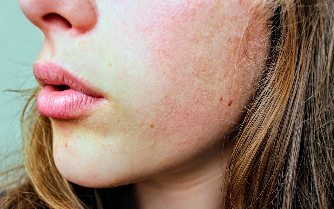 Acne Explained: Causes, Symptoms, and Common Myths